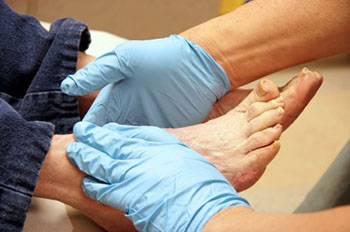 diabetic foot care in the Collin County, TX: Plano (Frisco, Allen, Murphy, Lucas) and Dallas County, TX: Garland, Carrollton, Richardson, Farmers Branch, Sachse, Addison areas