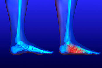 flat feet treatment in the Collin County, TX: Plano (Frisco, Allen, Murphy, Lucas) and Dallas County, TX: Garland, Carrollton, Richardson, Farmers Branch, Sachse, Addison areas