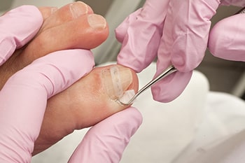Ingrown toenails treatment in the Collin County, TX: Plano (Frisco, Allen, Murphy, Lucas) and Dallas County, TX: Garland, Carrollton, Richardson, Farmers Branch, Sachse, Addison areas