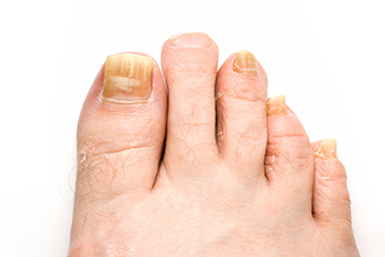 fungus toenails treatment in the Collin County, TX: Plano (Frisco, Allen, Murphy, Lucas) and Dallas County, TX: Garland, Carrollton, Richardson, Farmers Branch, Sachse, Addison areas