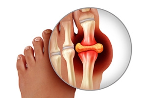 Sudden and Intense Toe Pain May Be Gout