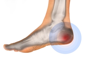 Types and Causes of Heel Pain