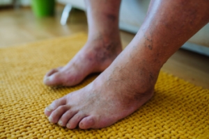 How Podiatrists Help Protect the Feet of People With Diabetes