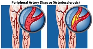 How Do Podiatrists Diagnose Peripheral Artery Disease?