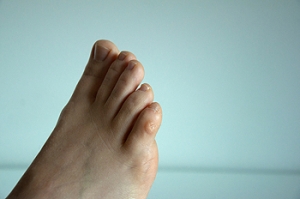 The Difference Between Corns and Calluses