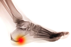 Possible Relief From Heel Spurs