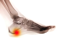 Possible Relief From Heel Spurs