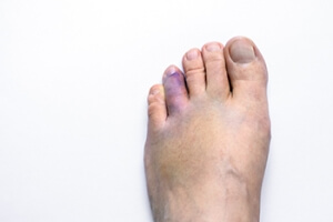 A Broken Toe Needs Rest