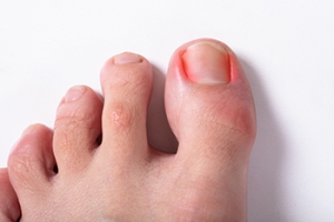 Ingrown Toenails and Their Lasting Solutions