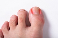 Ingrown Toenails and Their Lasting Solutions